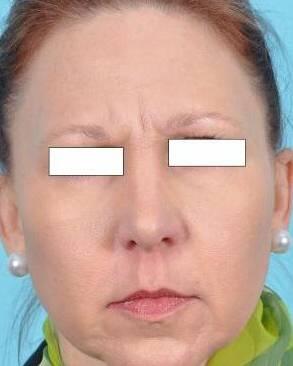BOTOX Cosmetic Before & After Image Patient 28005