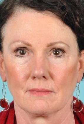 Facial Fillers Before & After Image Patient 28501