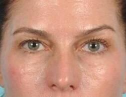 Facial Fillers Before & After Image Patient 28503