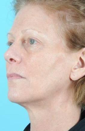 Laser Skin Resurfacing Before & After Image Patient 28601