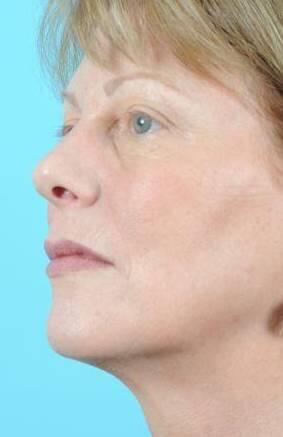 Laser Skin Resurfacing Before & After Image