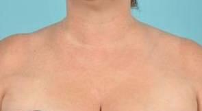 Laser Skin Resurfacing Before & After Image Patient 28603