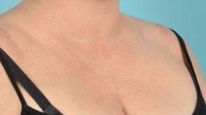 Laser Skin Resurfacing Before & After Image Patient 28603