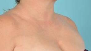 Laser Skin Resurfacing Before & After Image Patient 28603