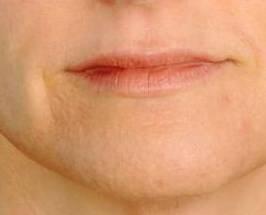 Lip Enhancement Before & After Image