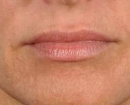 Lip Enhancement Before & After Image