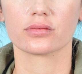 Lip Enhancement Before & After Image