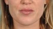 Lip Enhancement Before & After Image Patient 28704