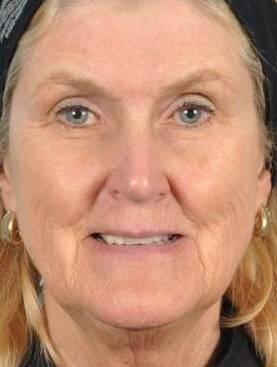 Microneedling Before & After Image