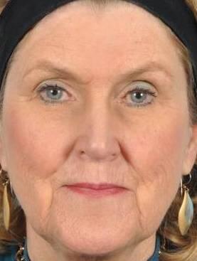 Microneedling Before & After Image Patient 28800