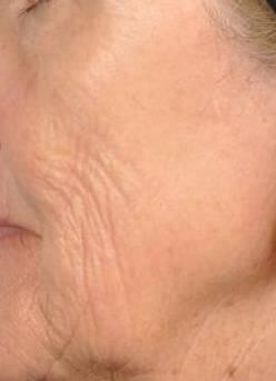 Microneedling Before & After Image Patient 28800