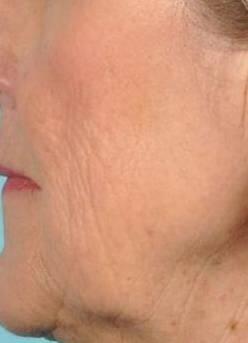 Microneedling Before & After Image Patient 28800