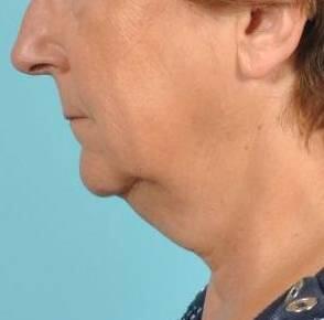 THERMItight Before & After Image
