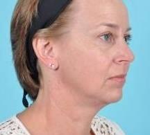 Ultherapy Before & After Image Patient 28950