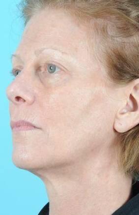 Ultherapy Before & After Image Patient 28952