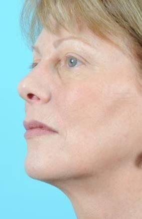 Ultherapy Before & After Image Patient 28952