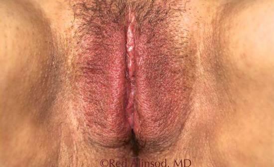 Vaginal Rejuvenation Before & After Image